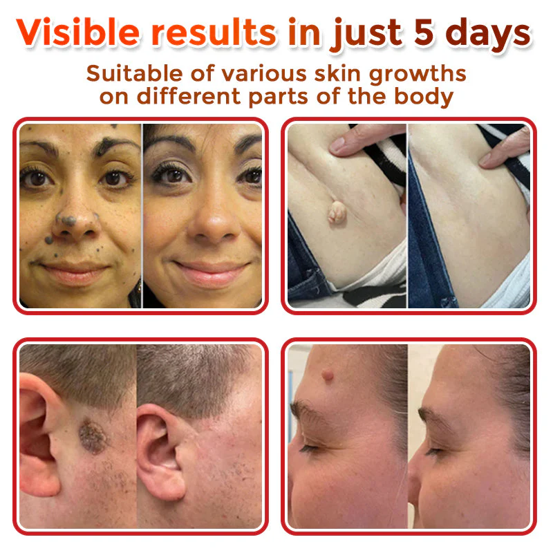BBOJI™ MicroNeedle Botanic Skin Tag Removal Patch 🇺🇸 Made in the USA