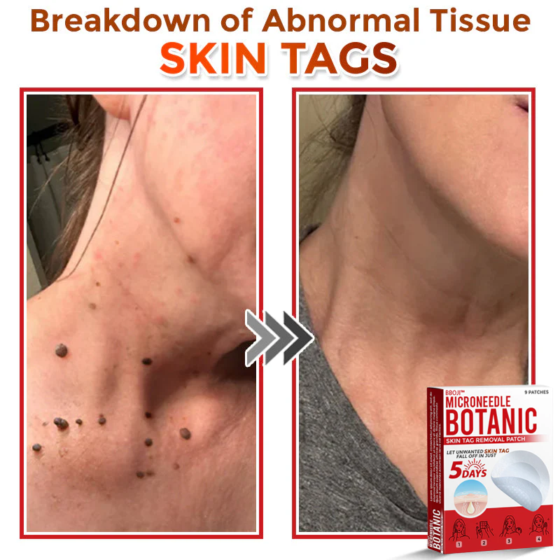 BBOJI™ MicroNeedle Botanic Skin Tag Removal Patch 🇺🇸 Made in the USA