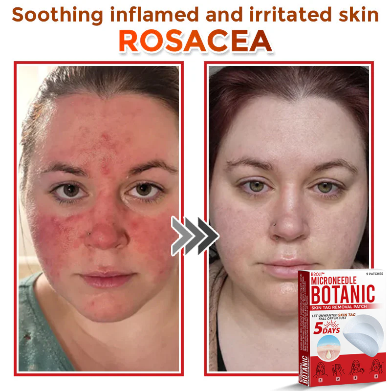 BBOJI™ MicroNeedle Botanic Skin Tag Removal Patch 🇺🇸 Made in the USA