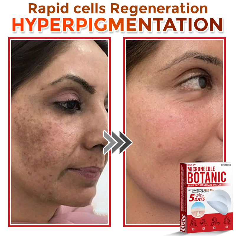BBOJI™ MicroNeedle Botanic Skin Tag Removal Patch 🇺🇸 Made in the USA