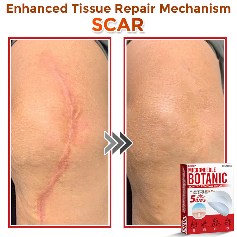 BBOJI™ MicroNeedle Botanic Skin Tag Removal Patch 🇺🇸 Made in the USA