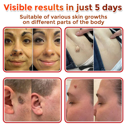 BBOJI™  MicroNeedle Botanic Skin Tag Removal Patch 🇺🇸 Made in the USA