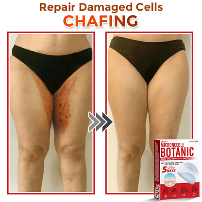 BBOJI™  MicroNeedle Botanic Skin Tag Removal Patch 🇺🇸 Made in the USA