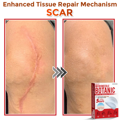 BBOJI™  MicroNeedle Botanic Skin Tag Removal Patch 🇺🇸 Made in the USA