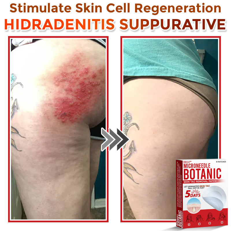 BBOJI™  MicroNeedle Botanic Skin Tag Removal Patch 🇺🇸 Made in the USA