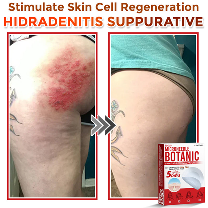BBOJI™  MicroNeedle Botanic Skin Tag Removal Patch 🇺🇸 Made in the USA