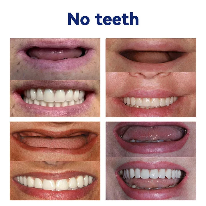 NESLEMY™-🦷Advanced Customized Full Denture Set – For a Perfect Smile and Natural Comfort🥰( 🔥Last Day Promotion🔥）