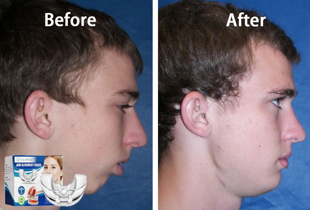 š„Vaxfliteā¢Mandibular Corrector-For a Healthier, More Aligned Smileš¦·š„